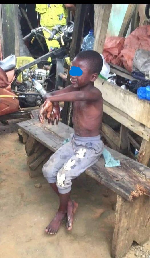 Akoupé-Zeudji : Une marâtre brûle les mains de l’enfant de son mari pour avoir volé 10.000Fcfa