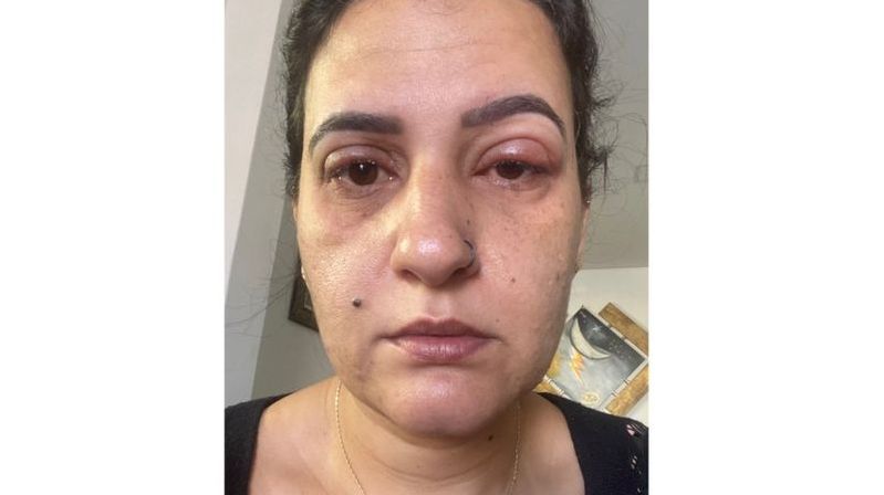 « J'ai fini à l'hôpital à cause de mes faux cils », témoigne une infirmière